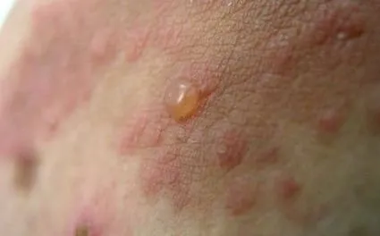 herpetiform dermatitis
