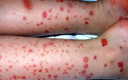 allergiás
