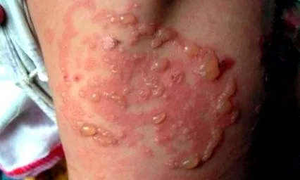 dermatitisben