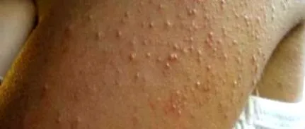dermatitisben szenvedő