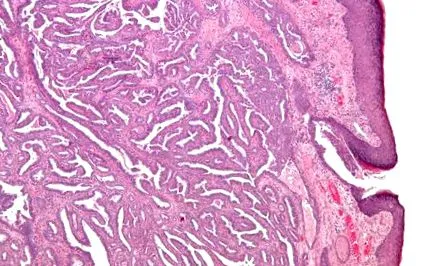papilloma vírus