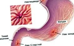 reflux