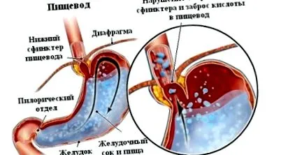 reflux