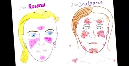 дисбиоза дисбиоза розацеа