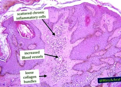 fibroepithelialis