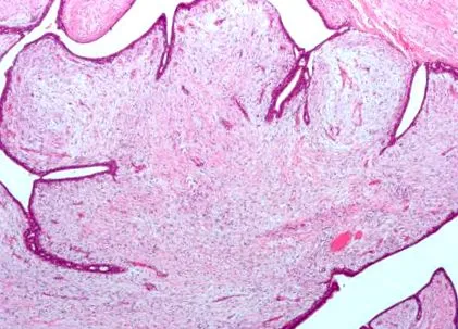 fibroepithelialis papilloma