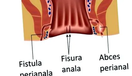 fortius