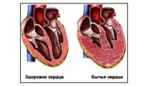Вплив алкоголю на серце та судини наслідки вплив
