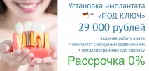 Dinte pe un implant la cheie 29900 de ruble, implant dentar în Perm la un super preț