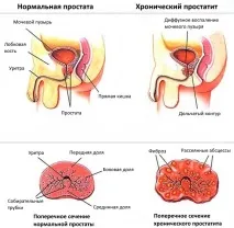 простатит