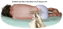 ДІАГНОСТИКА РАКУ МОЗКУ діагностика