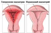 ЕНДОМЕТРІЯ МАТКИ НОРМА ПРИ МЕНОПАУЗІ Що таке гіпертрофія ендометрію, Швидкий виклик ендометрія
