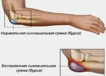 Гнійний бурсит ліктьового суглоба симптоми, лікування операцією та в домашніх умовах ліктьового
