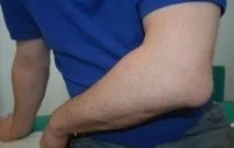 Гнійний бурсит ліктьового суглоба симптоми, лікування операцією та в домашніх умовах гнійний