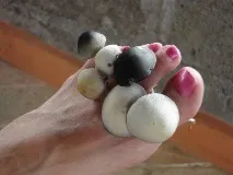 Грибок між пальцями ніг пальцями