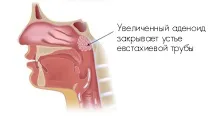 ЯК ЛІКУВАТИ АДЕНОЇДИ КЕМБРІЙСЬКОЇ Блакитної глини кембрійської