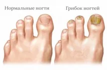 Як побороти грибок нігтів і почати носити відкрите взуття без сором’язливості нігтів