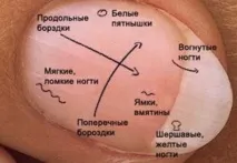 Як визначити хворобу по нігтях визначити