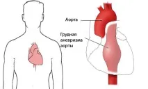 Кашель при серцевих захворюваннях про що говорить і як лікується кашель