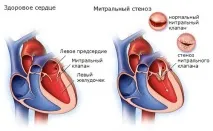 Кашель при серцевих захворюваннях про що говорить і як лікується захворюваннях