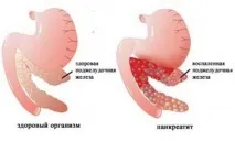Лікування та профілактика симптомів панкреатиту народними засобами (обговрення) профілактика