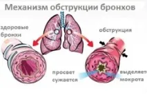 Лікування хронічного обструктивного бронхіту у дорослих дорослих