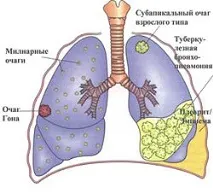 лечение