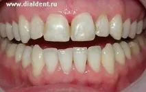 Ми не практикуємо деякі методи лікування каналів! лікування