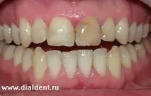 Ми не практикуємо деякі методи лікування каналів! деякі