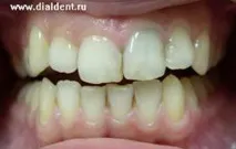 Ми не практикуємо деякі методи лікування каналів! деякі