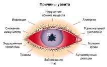 Увеїт очі – причини, симптоми талікування талікування