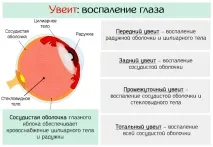 Увеїт очі – причини, симптоми талікування увеїт