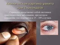 Увеїт очі – причини, симптоми талікування причини