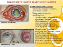 Увеїт очі – причини, симптоми талікування талікування