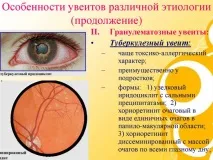 Увеїт очі – причини, симптоми талікування причини
