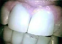 diamondbrite