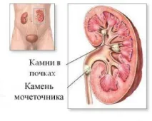 Оксалатні камені в нирках, що це Дієта, харчування, продукти дієта