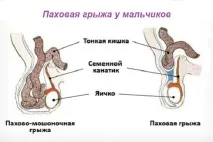 Пахвинна грижа у дитини, причини виникнення, операція дитини