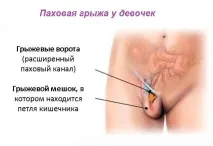 Пахвинна грижа у дитини, причини виникнення, операція дитини