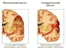 Перші ознаки інсульту – перша допомога при інсульті інсульту