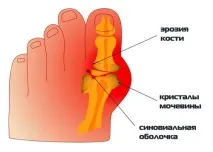 Подагра ознаки, лікування лікування