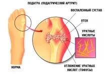 Подагра у людей похилого віку симптоми та лікування народними засобами похилого