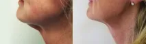 Переваги методики омолодження особи Face Tite переваги