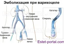 Варикоцеле небезпечне захворювання молодих чоловіків небезпечне