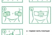 Пупкова грижа після операції реабілітація та харчування пупкова