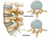 Proeminența discurilor coloanei vertebrale lombosacrale simptome și tratament