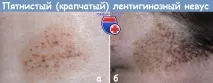 Просте лентиго у дитини лентигіноз