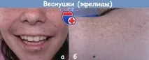 Просте лентиго у дитини дитини