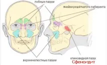 Сфеноїдит симптоми та лікування запалення клиноподібної пазухи симптоми