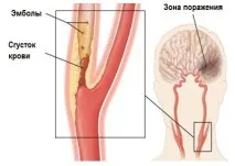 симптоми